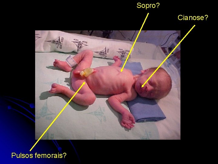 Sopro? Cianose? Pulsos femorais? 