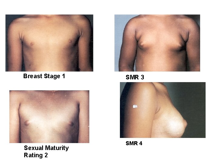 Breast Stage 1 Sexual Maturity Rating 2 SMR 3 SMR 4 
