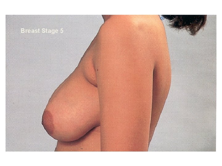 Breast Stage 5 