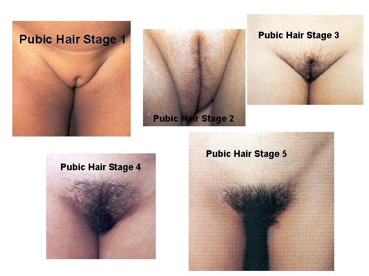 Pubic Hair Stage 3 Pubic Hair Stage 1 Pubic Hair Stage 2 Pubic Hair