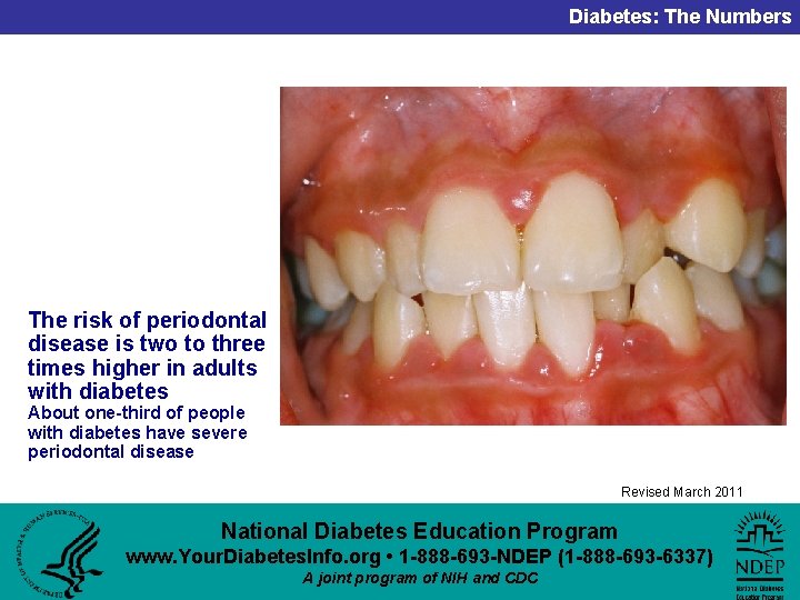 Diabetes: The Numbers The risk of periodontal disease is two to three times higher