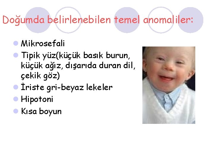 Doğumda belirlenebilen temel anomaliler: l Mikrosefali l Tipik yüz(küçük basık burun, küçük ağız, dışarıda