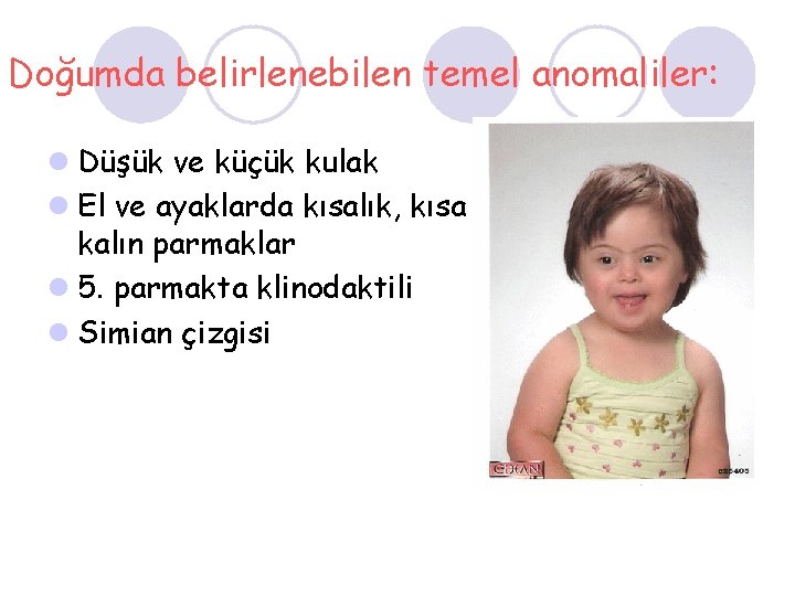Doğumda belirlenebilen temel anomaliler: l Düşük ve küçük kulak l El ve ayaklarda kısalık,
