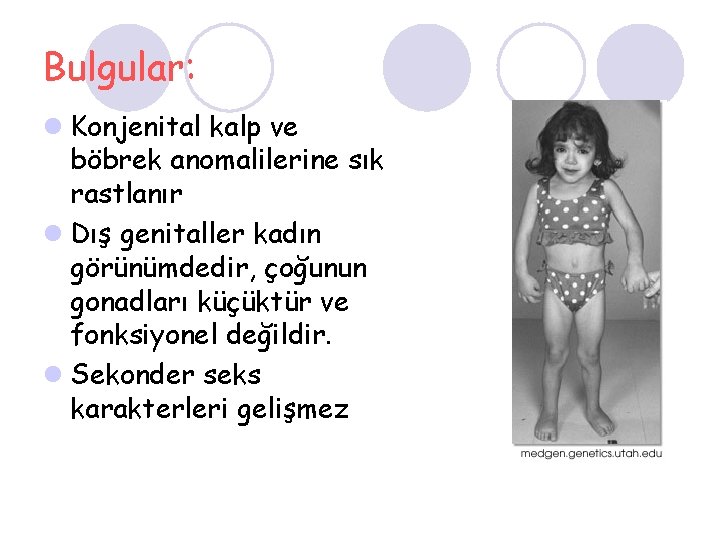 Bulgular: l Konjenital kalp ve böbrek anomalilerine sık rastlanır l Dış genitaller kadın görünümdedir,