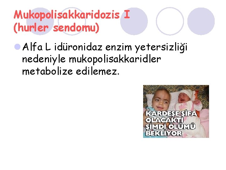 Mukopolisakkaridozis I (hurler sendomu) l Alfa L idüronidaz enzim yetersizliği nedeniyle mukopolisakkaridler metabolize edilemez.