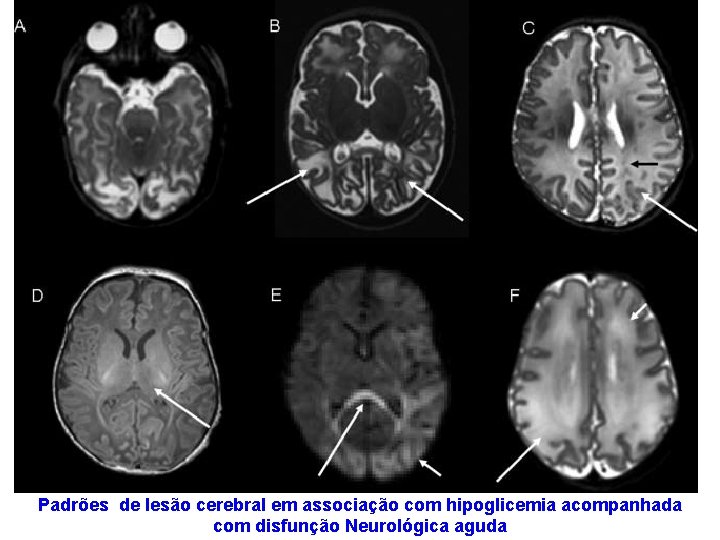 Padrões de lesão cerebral em associação com hipoglicemia acompanhada com disfunção Neurológica aguda 