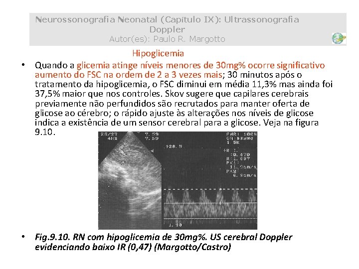 Neurossonografia Neonatal (Capítulo IX): Ultrassonografia Doppler Autor(es): Paulo R. Margotto Hipoglicemia • Quando a