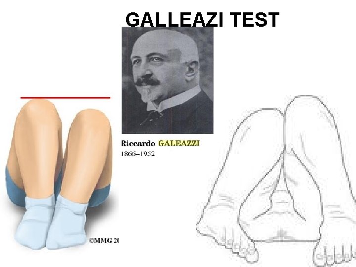 GALLEAZI TEST 