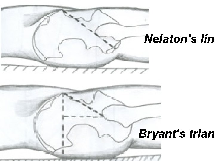 Nelaton's line Bryant's triang 