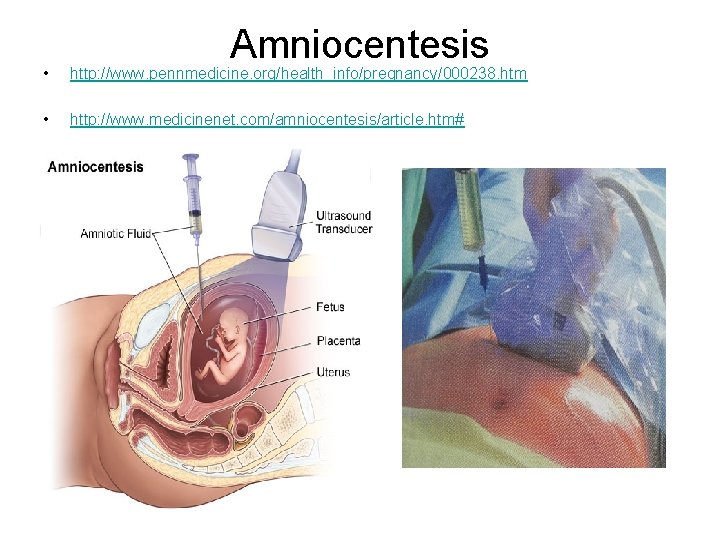 Amniocentesis • http: //www. pennmedicine. org/health_info/pregnancy/000238. htm • http: //www. medicinenet. com/amniocentesis/article. htm# 
