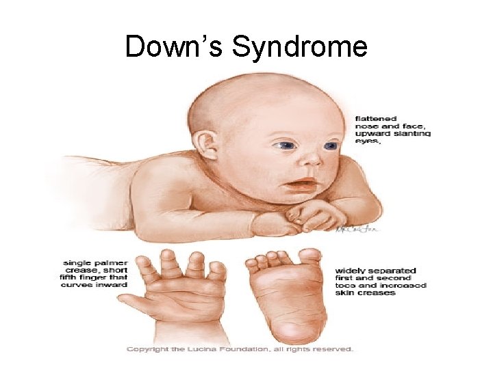 Down’s Syndrome 