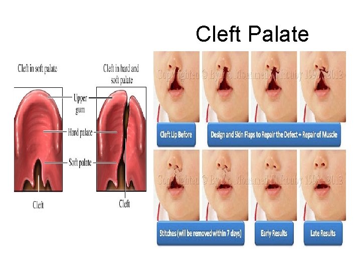 Cleft Palate 
