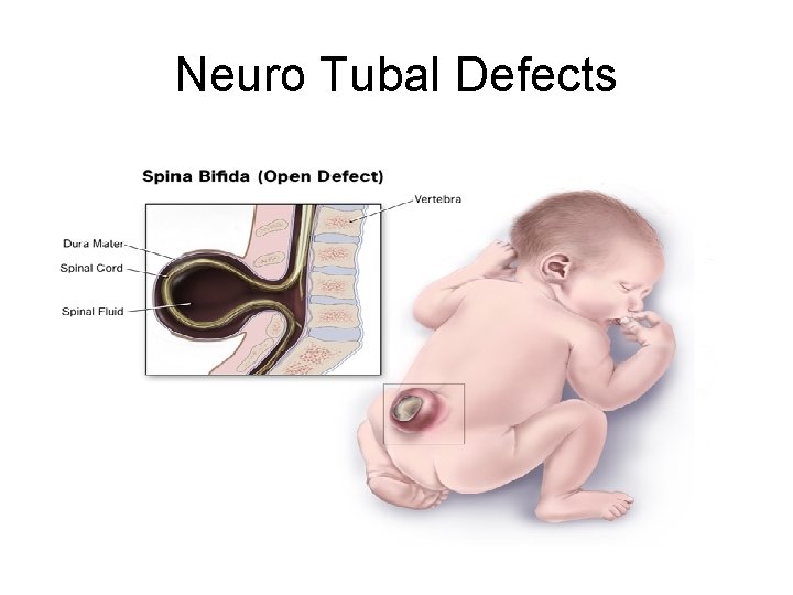 Neuro Tubal Defects 
