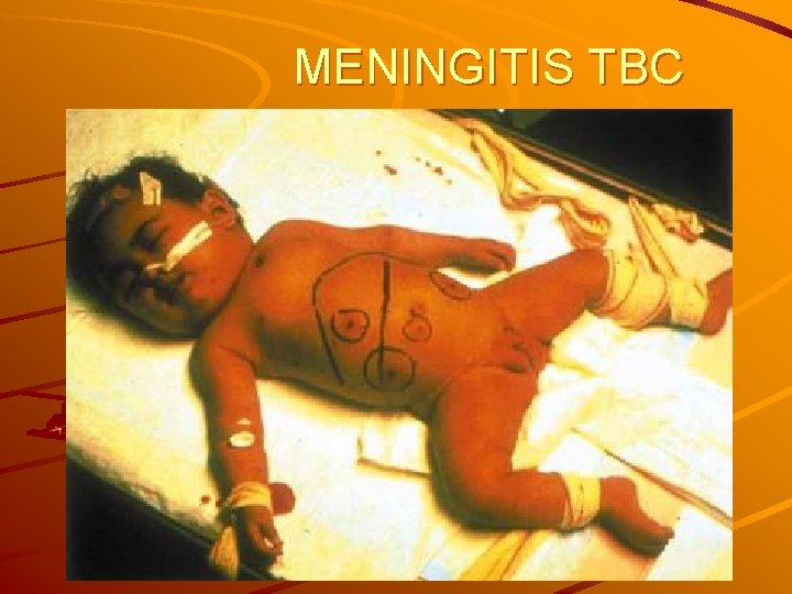 MENINGITIS TBC 
