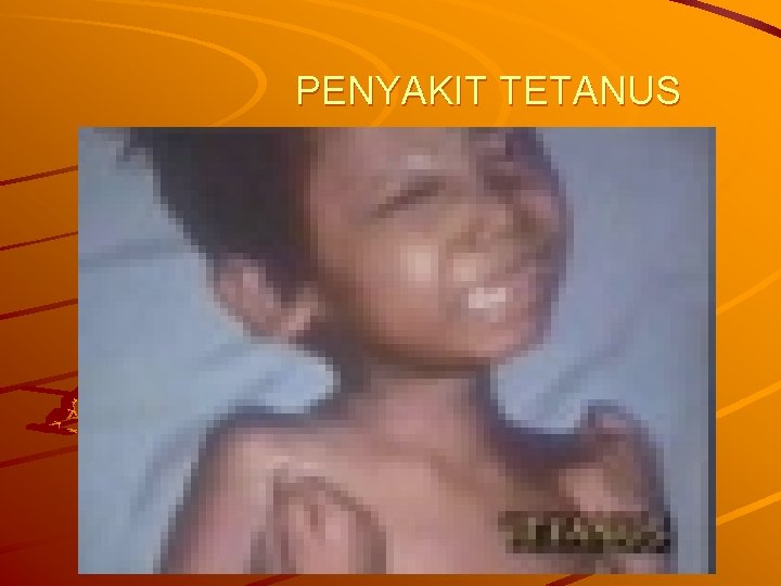 PENYAKIT TETANUS 