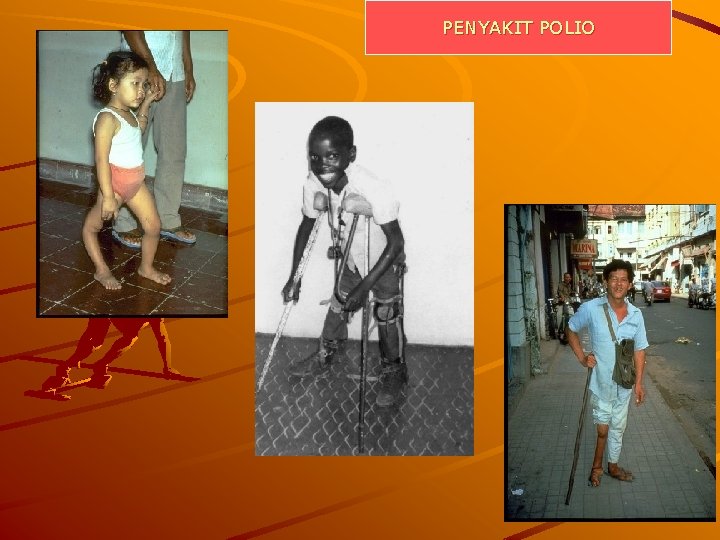 PENYAKIT POLIO 