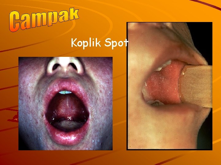 Koplik Spot 