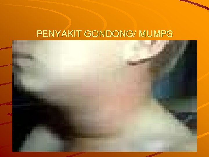 PENYAKIT GONDONG/ MUMPS 
