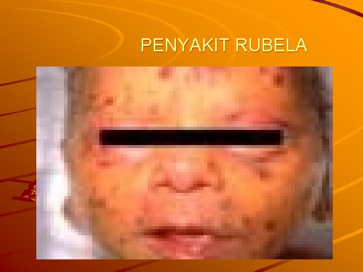 PENYAKIT RUBELA 