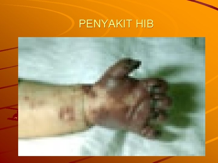 PENYAKIT HIB 