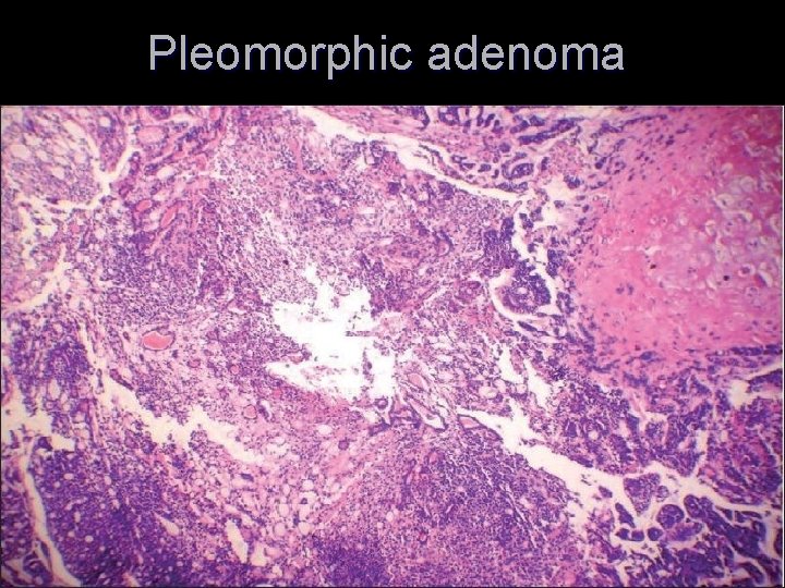 Pleomorphic adenoma 