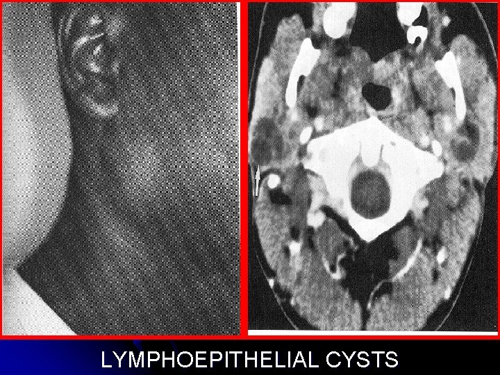 LYMPHOEPITHELIAL CYSTS 