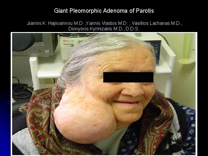 Giant Pleomorphic Adenoma of Parotis Jiannis K. Hajiioannou M. D. , Yannis Vlastos M.