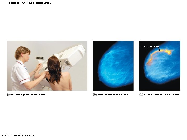 Figure 27. 18 Mammograms. Malignancy Mammogram procedure © 2013 Pearson Education, Inc. Film of
