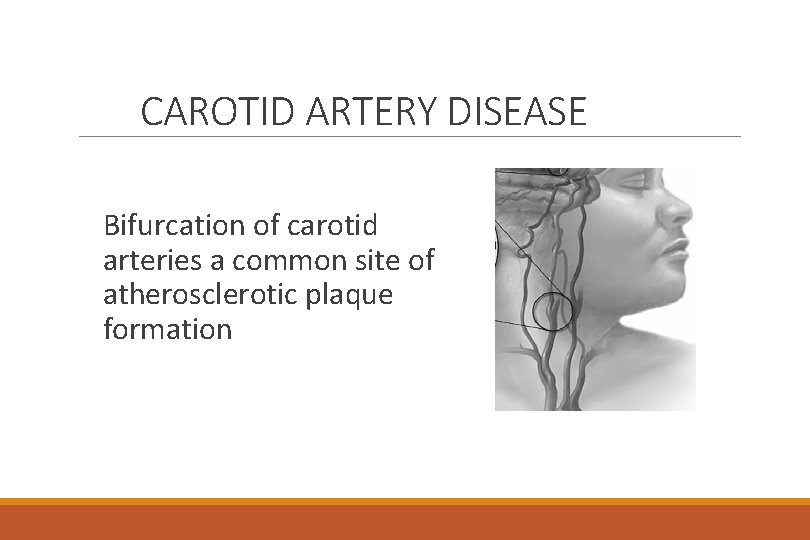 CAROTID ARTERY DISEASE Bifurcation of carotid arteries a common site of atherosclerotic plaque formation