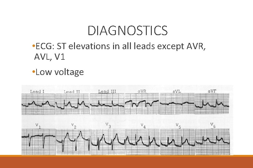 DIAGNOSTICS • ECG: ST elevations in all leads except AVR, AVL, V 1 •