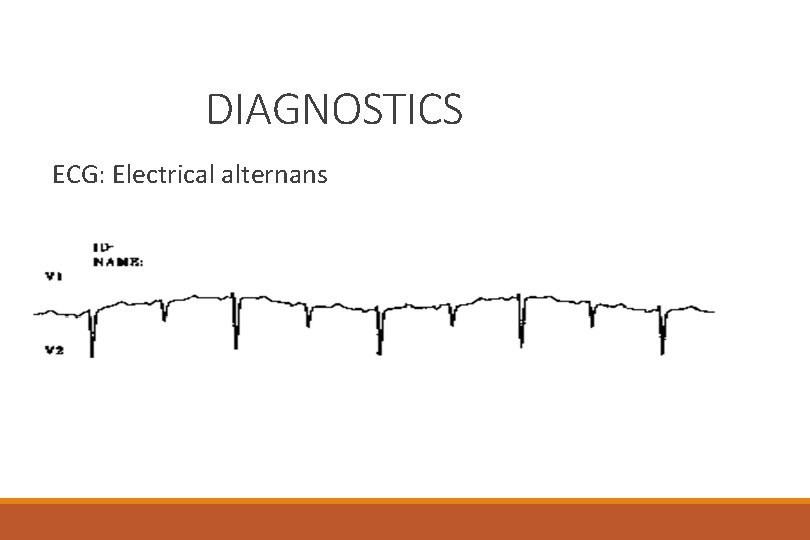 DIAGNOSTICS ECG: Electrical alternans 