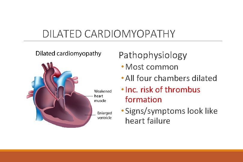 DILATED CARDIOMYOPATHY Pathophysiology • Most common • All four chambers dilated • Inc. risk