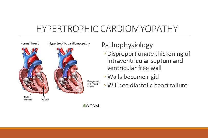HYPERTROPHIC CARDIOMYOPATHY Pathophysiology ◦ Disproportionate thickening of intraventricular septum and ventricular free wall ◦
