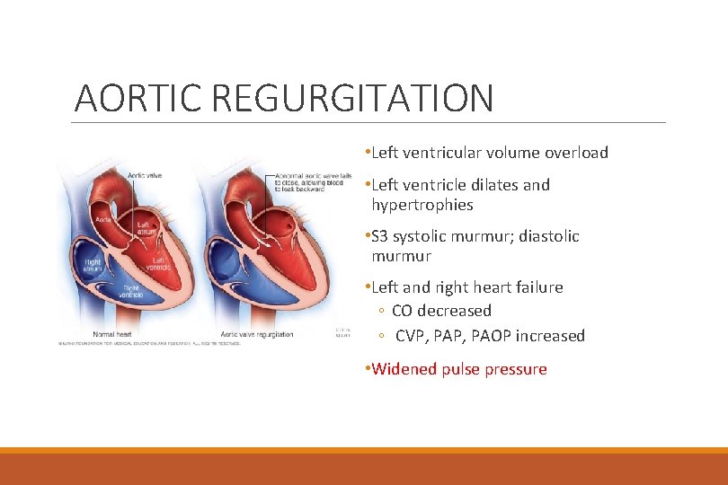 AORTIC REGURGITATION • Left ventricular volume overload • Left ventricle dilates and hypertrophies •