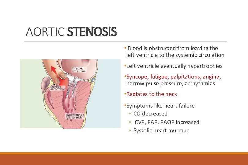 AORTIC STENOSIS • Blood is obstructed from leaving the left ventricle to the systemic