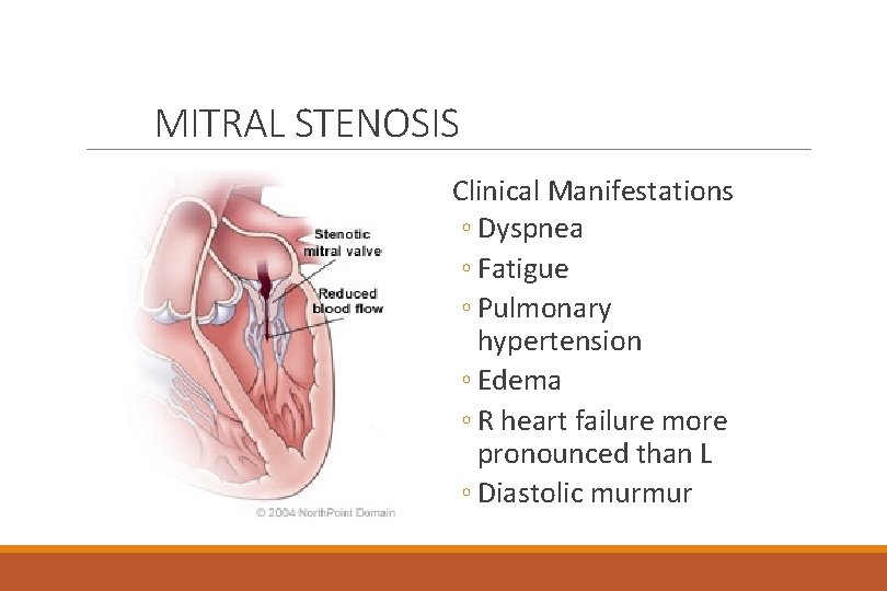 MITRAL STENOSIS Clinical Manifestations ◦ Dyspnea ◦ Fatigue ◦ Pulmonary hypertension ◦ Edema ◦