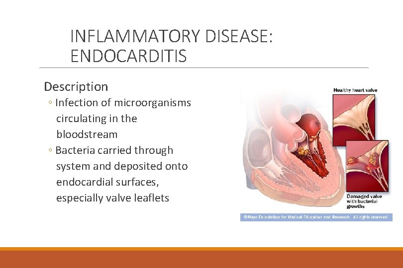 INFLAMMATORY DISEASE: ENDOCARDITIS Description ◦ Infection of microorganisms circulating in the bloodstream ◦ Bacteria