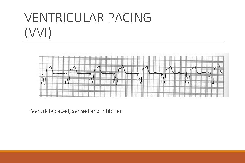 VENTRICULAR PACING (VVI) Ventricle paced, sensed and inhibited 