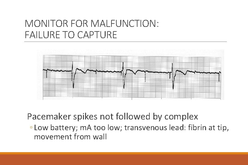 MONITOR FOR MALFUNCTION: FAILURE TO CAPTURE Pacemaker spikes not followed by complex ◦ Low