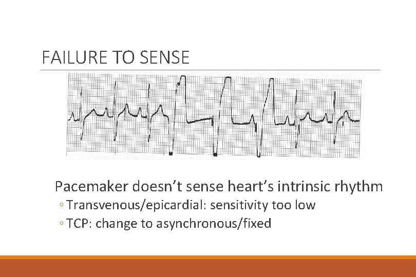 FAILURE TO SENSE Pacemaker doesn’t sense heart’s intrinsic rhythm ◦ Transvenous/epicardial: sensitivity too low