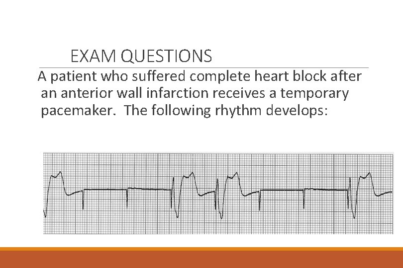 EXAM QUESTIONS A patient who suffered complete heart block after an anterior wall infarction