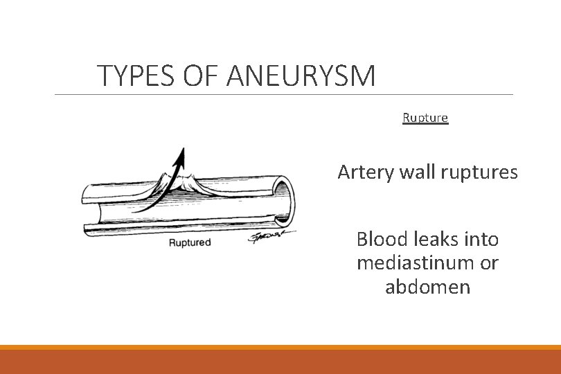 TYPES OF ANEURYSM Rupture Artery wall ruptures Blood leaks into mediastinum or abdomen 