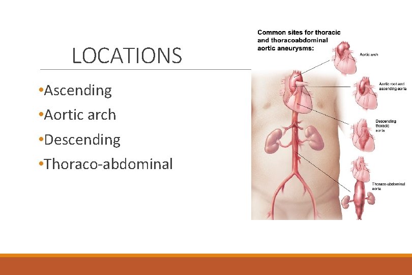 LOCATIONS • Ascending • Aortic arch • Descending • Thoraco-abdominal 