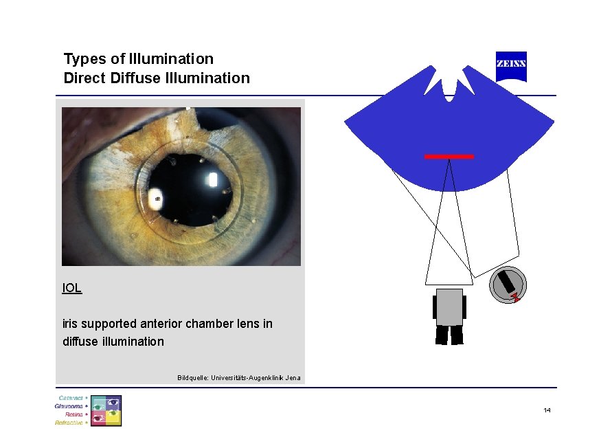 Types of Illumination Direct Diffuse Illumination IOL iris supported anterior chamber lens in diffuse