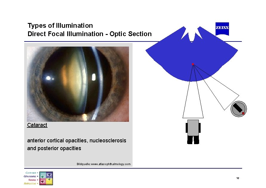 Types of Illumination Direct Focal Illumination - Optic Section Cataract anterior cortical opacities, nucleosclerosis