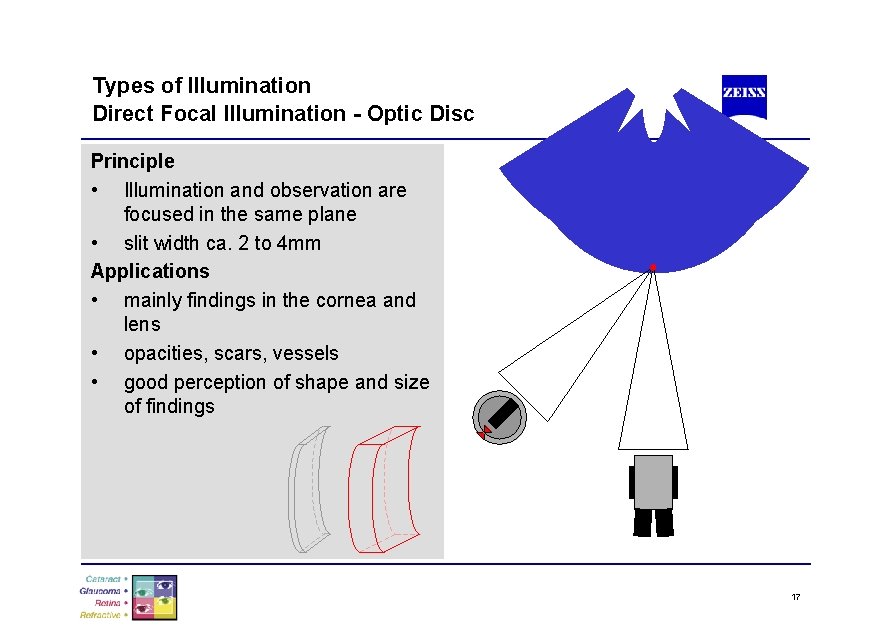 Types of Illumination Direct Focal Illumination - Optic Disc Principle • Illumination and observation