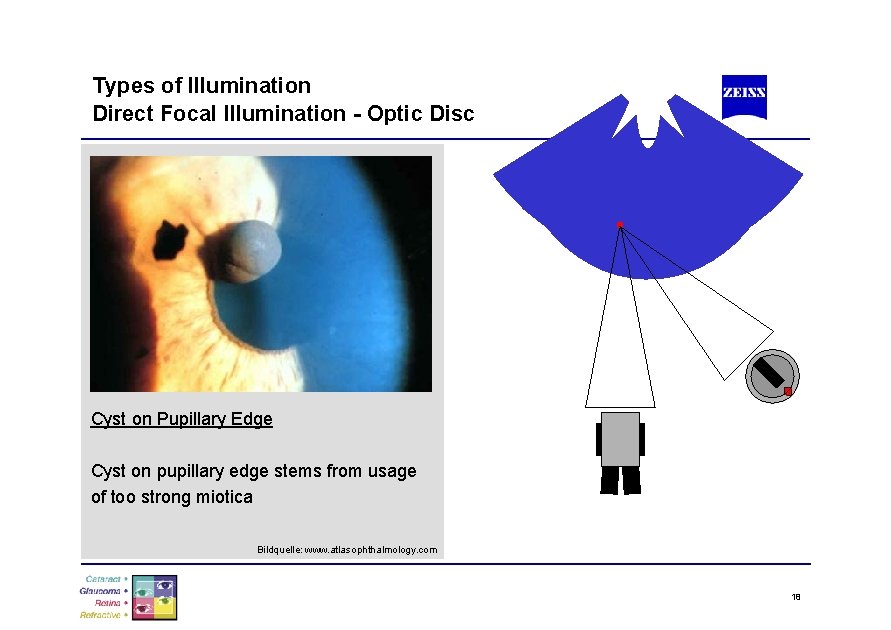 Types of Illumination Direct Focal Illumination - Optic Disc Cyst on Pupillary Edge Cyst
