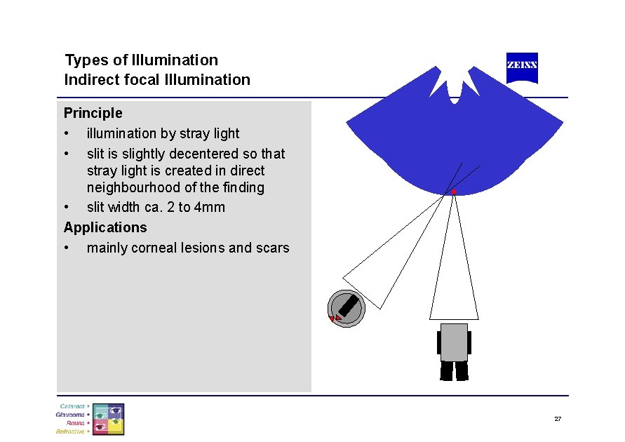 Types of Illumination Indirect focal Illumination Principle • illumination by stray light • slit