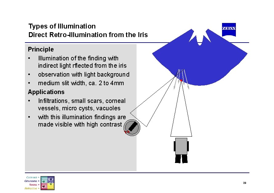 Types of Illumination Direct Retro-Illumination from the Iris Principle • Illumination of the finding