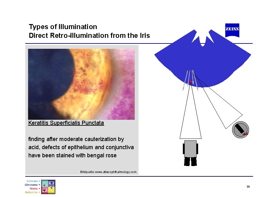 Types of Illumination Direct Retro-Illumination from the Iris Keratitis Superficialis Punctata finding after moderate